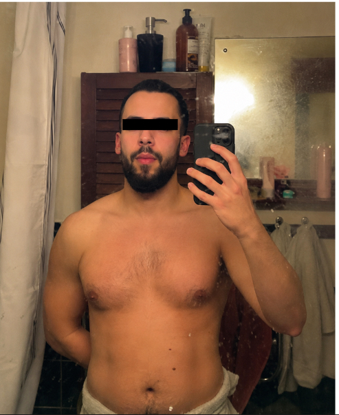 Before — bloated, inflamed, IBD active